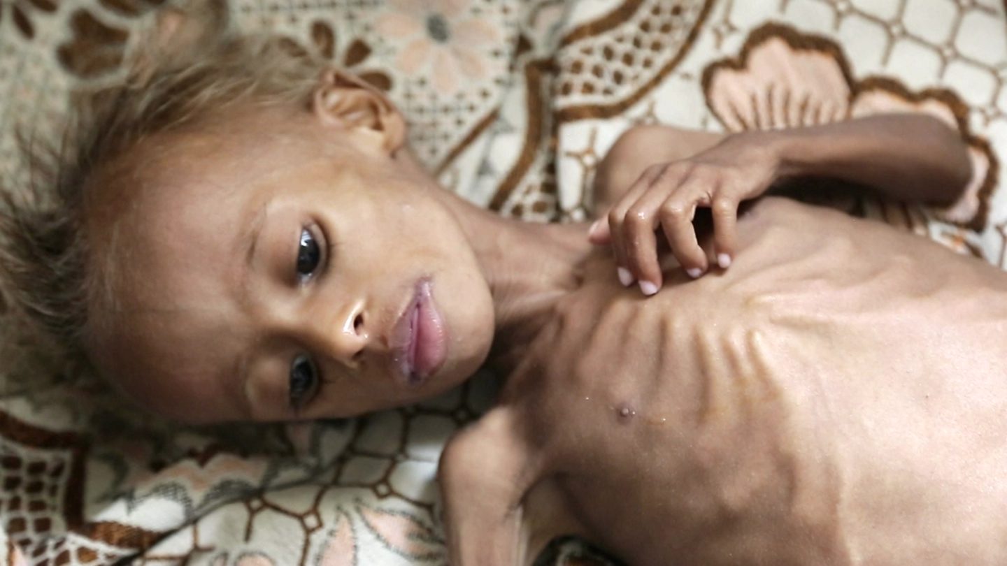 Image result for starvation in Yemen